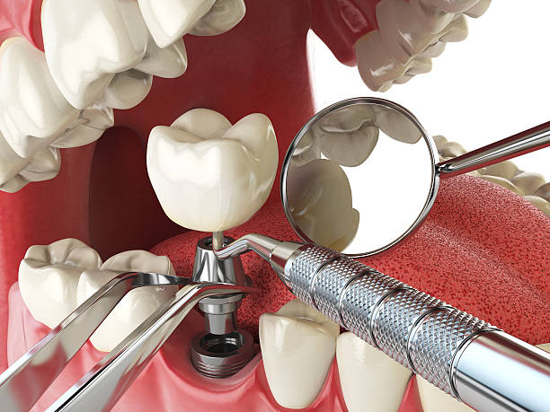 Best Emergency Root Canal Treatment in Delavan Lake, WI